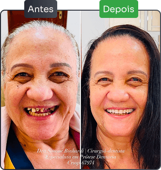 resultado implante dentário e reabiltação oral em são josé do rio preto