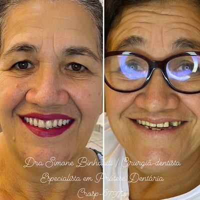 resultado implante dentário em são josé do rio preto 2