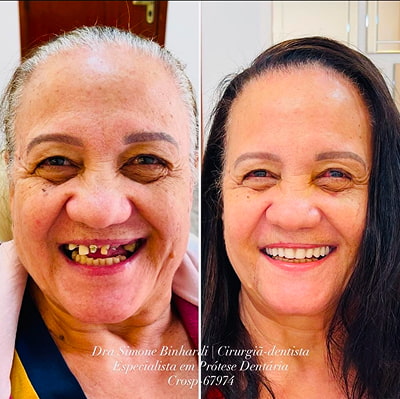 resultado implante dentário em são josé do rio preto 3