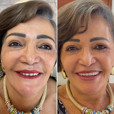 resultado implante dentário em são josé do rio preto 4