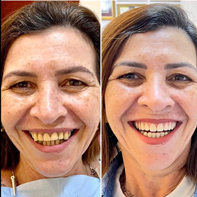 resultado implante dentário em são josé do rio preto 5